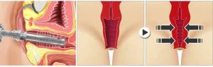 Laser Vaginal