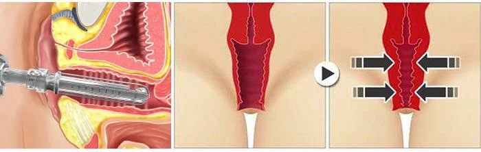 Laser Vaginal
