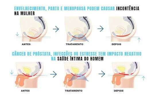 cadeira emsella